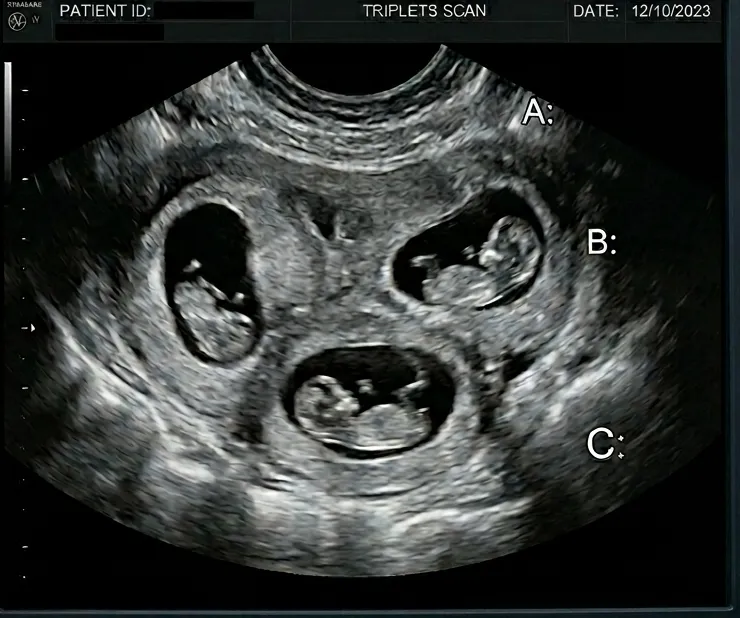 Fetal Reduction